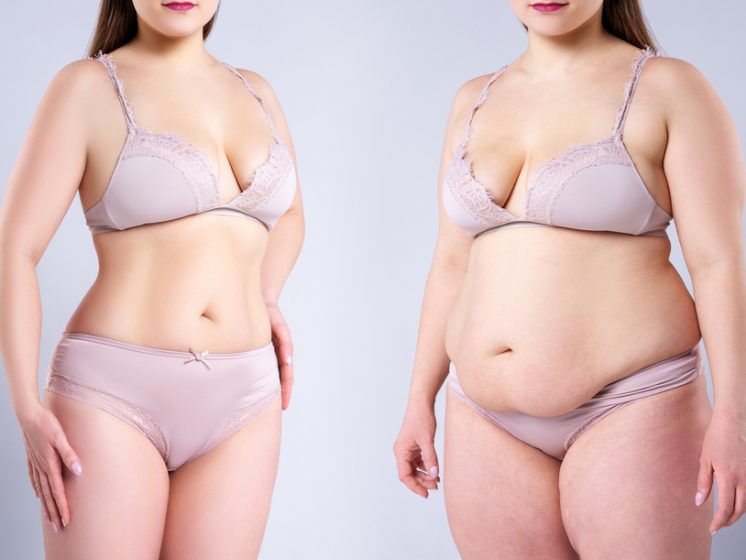 Tips that will help you get best Tummy Tuck Results – My Blog